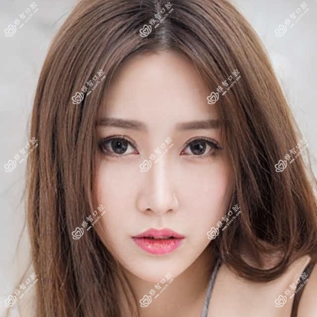 无锡下巴后缩正颌手术2025价目表:脸型不对称正颌手术150000+下巴后缩正颌手术30000+双颌前突正颌手术30000+凸嘴正颌手术40000+