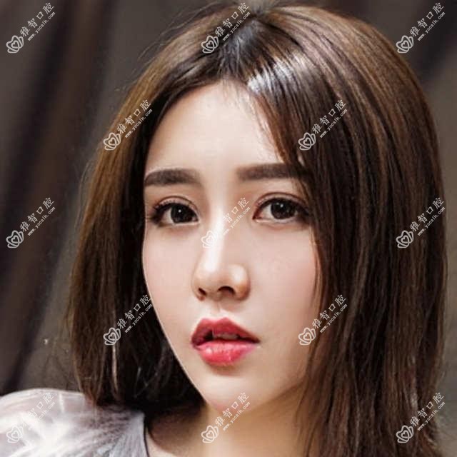 厦门集美区医院龅牙牙齿矫正多少钱?龅牙牙齿矫正4360元