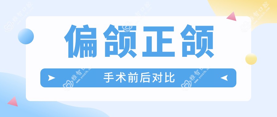 偏颌正颌手术前后对比