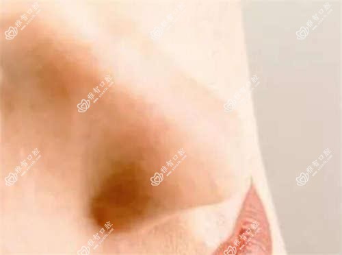 正雅考虑因素有哪些 正雅手术疼吗?以及恢复时间介绍