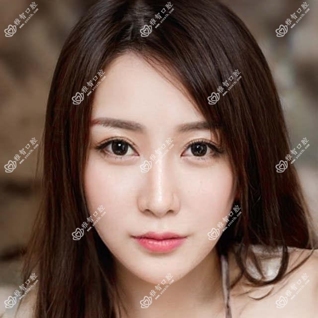 全瓷牙怎么样 全瓷牙相关治疗优缺点以及禁忌人群