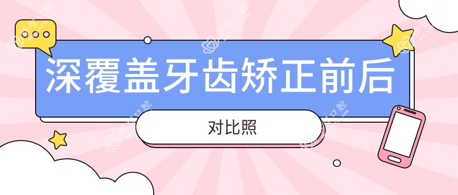 深覆盖牙齿矫正前后对比照