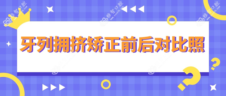 牙列拥挤矫正前后对比照