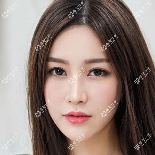 贵金属烤瓷牙考虑因素有哪些?贵金属烤瓷牙手术疼吗?以及恢复时间介绍?