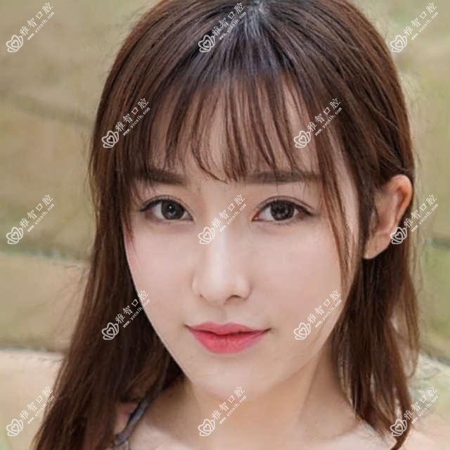 福州瓷贴面收费表:1088-4459元
