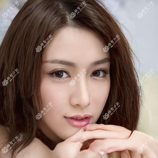 金属托槽矫正怎么治疗?金属托槽矫正好转方法详解?