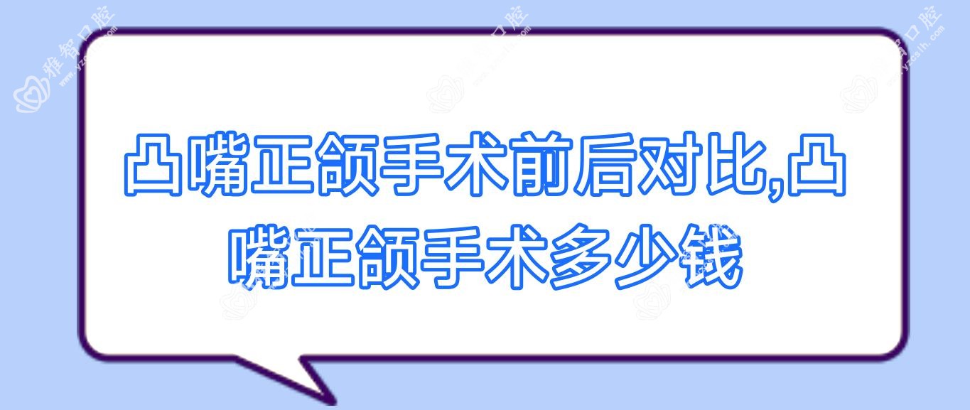 凸嘴正颌手术前后对比,凸嘴正颌手术多少钱
