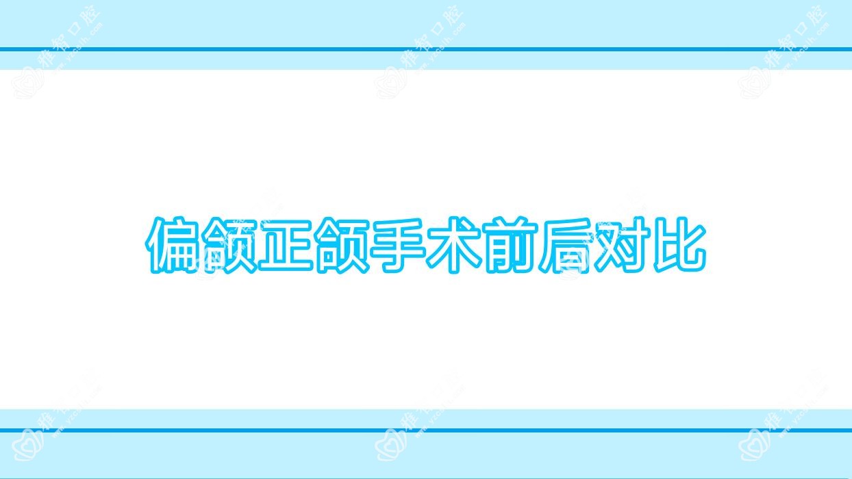 偏颌正颌手术前后对比