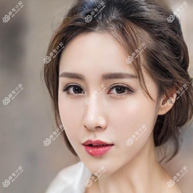 昆明深覆合牙齿矫正价格表:昆明深覆合牙齿矫正市场均价及各医院报价参考