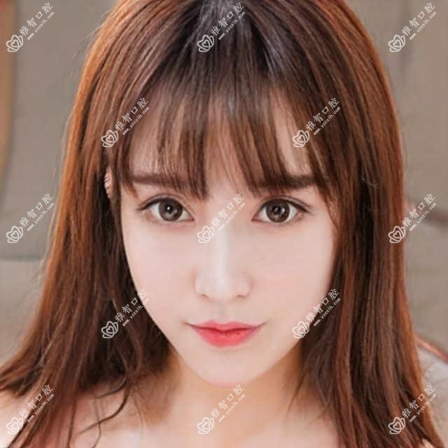 西安牙齿瓷贴面费用2025年新详细公布-西安交通大学口腔医院/壹加壹口腔美学矫正中心 牙齿瓷贴面收费表(价格)