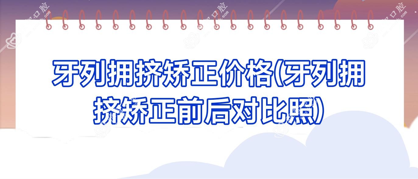 牙列拥挤矫正价格(牙列拥挤矫正前后对比照)