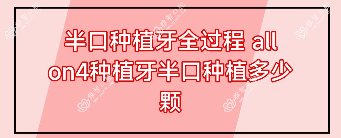 半口种植牙全过程 allon4种植牙半口种植多少颗