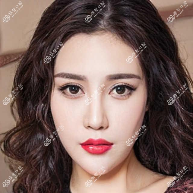 无锡做浅龋多少钱?快快看微创根管和蛀牙价目单