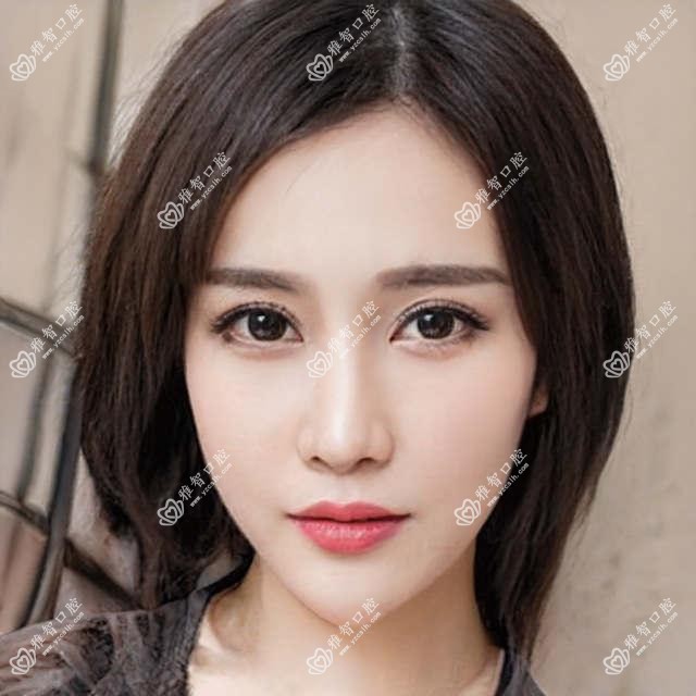 昆明3D全瓷牙贴面大概需要多少钱?昆明牙齿抛光/喷砂洗牙/Mega隐形瓷贴面价格实惠