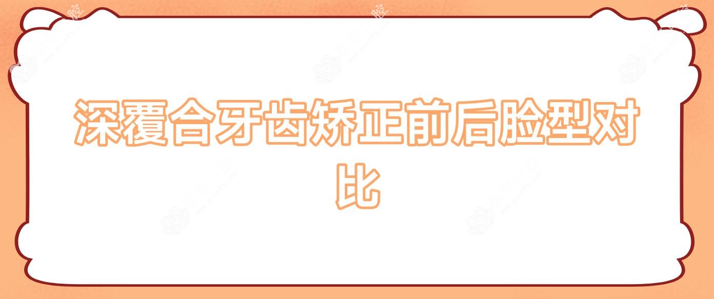 深覆合牙齿矫正前后脸型对比