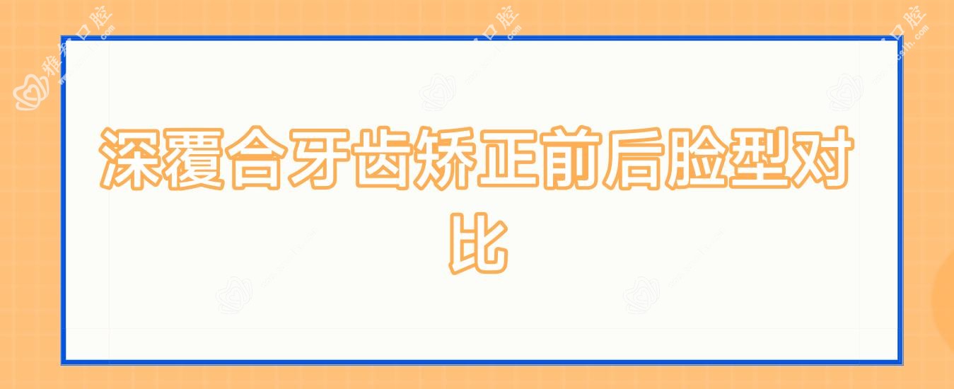 深覆合牙齿矫正前后脸型对比