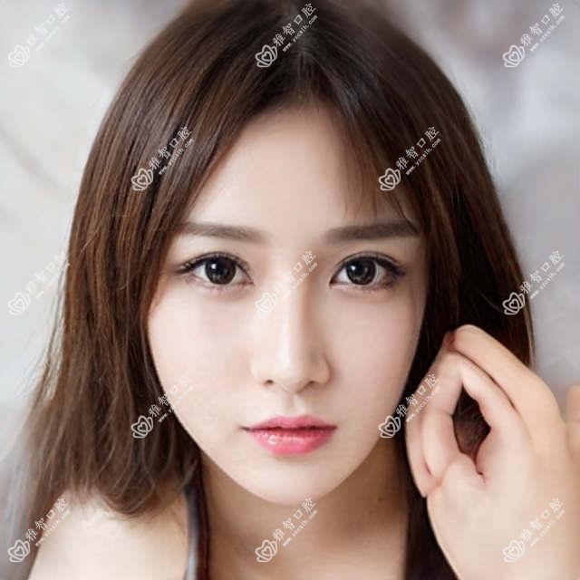 绍兴韩国dio种植牙价格多少钱？2025价目单：瑞士ITI种植牙1.2w元起、ITI瑞锆种植牙2w元起