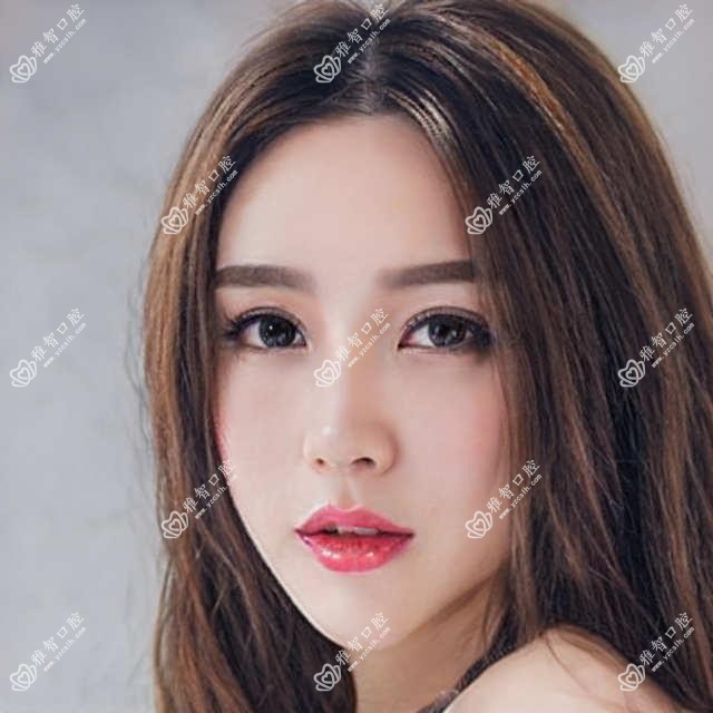 哈尔滨做固定托槽矫正器多少钱?快点看固定托槽矫正器和舌侧矫正器价目单