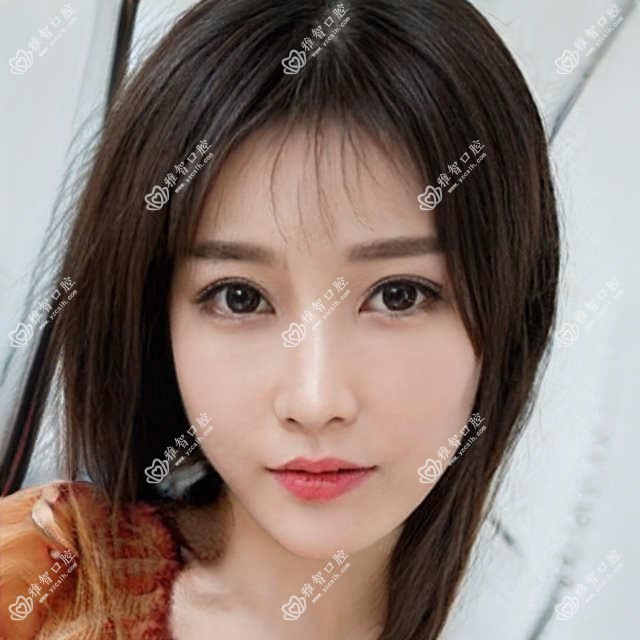 瓷贴面怎么治疗?瓷贴面相关治疗优缺点以及禁忌人群?