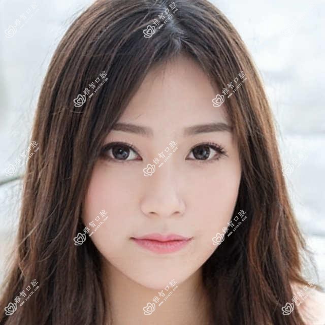 自锁托槽矫正的详细资料,自锁托槽矫正相关治疗优缺点以及禁忌人群