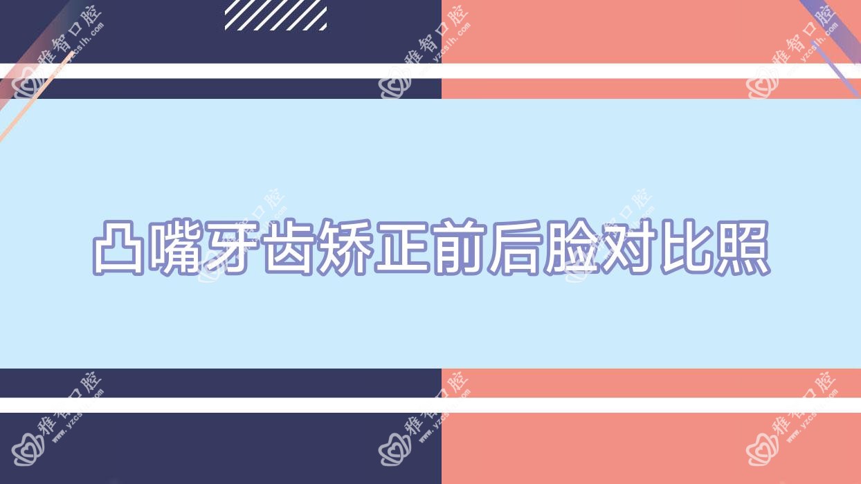 凸嘴牙齿矫正前后脸对比照