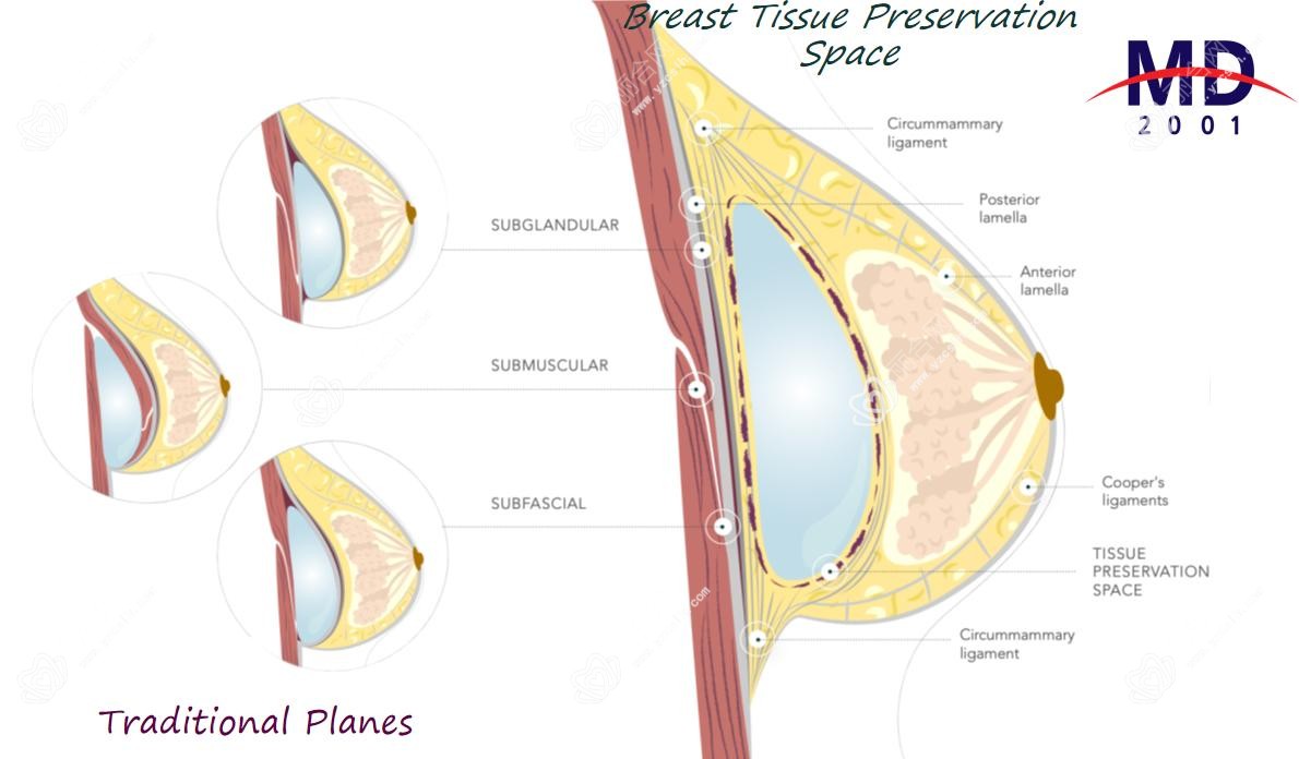 假体隆胸会不会影响母乳喂养