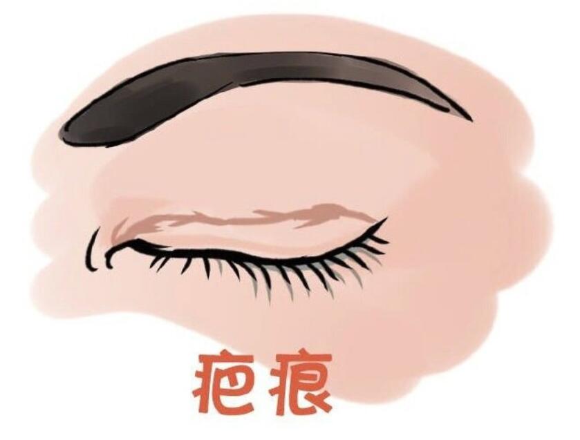 郑州赵丽双眼皮修复费用初次修复8000元起，多次修复可能要两三万