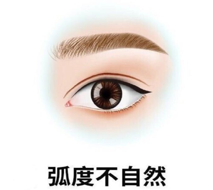 赵丽双眼皮修复费用