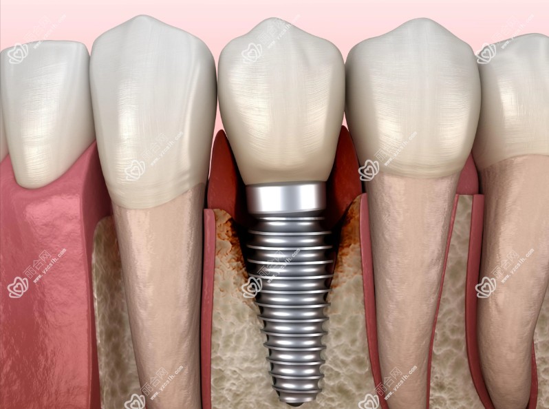 种植牙的寿命一般多少年？20-30年不是终点，维护才是关键