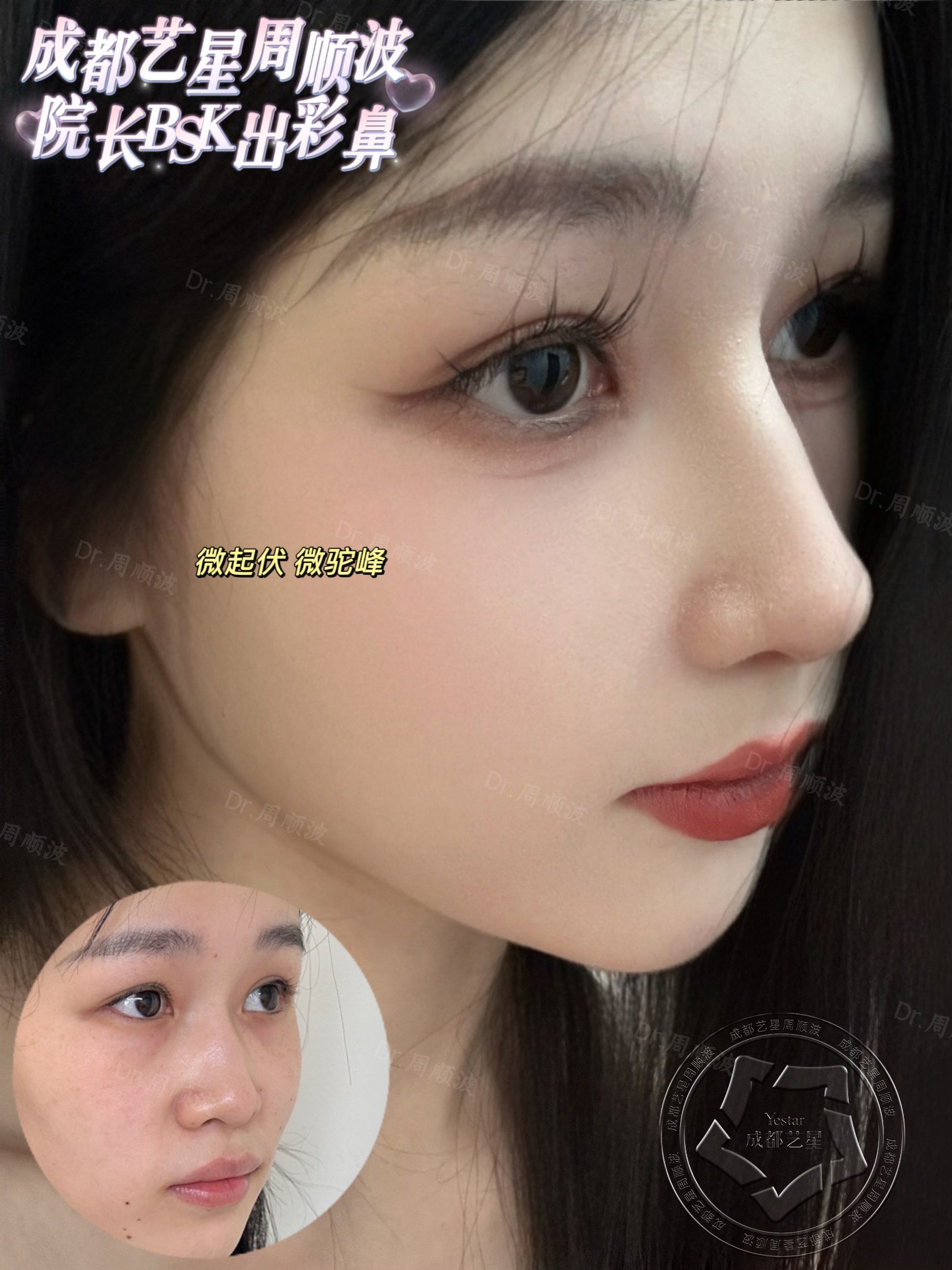 成都艺星谢雯玻尿酸填充价格2026年全网最全！从880元到80900元全项目揭秘