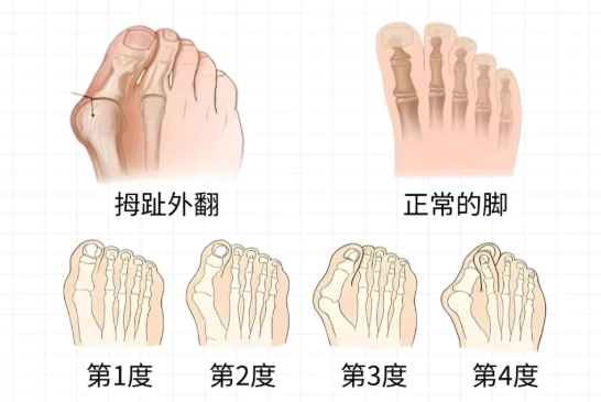 二、德宏哪家医院做拇外翻手术比较好?昆明医院优势分析