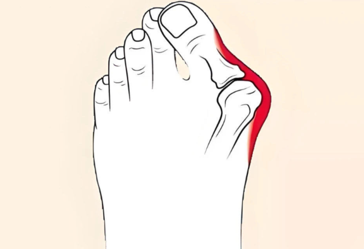 四、昆明哪家医院做拇指外翻手术?医院对比分析