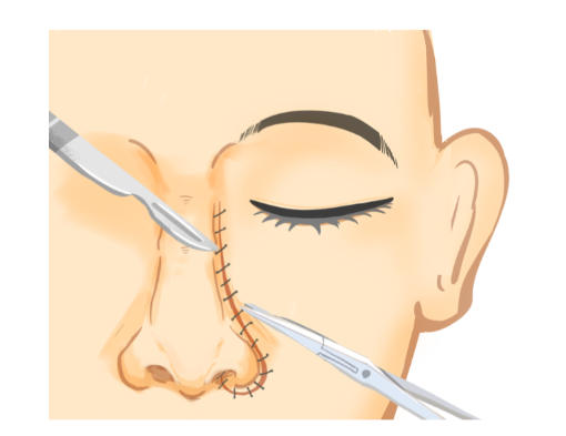 杭州任东隆鼻在浙医二院国际医学中心吗？4-7万价格透明效果自然口碑好！