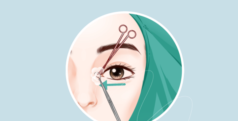 五、韩勋修复内眼角成功的实例分享