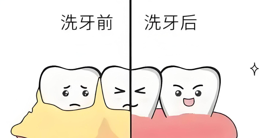 二、洗牙的原理与步骤解析