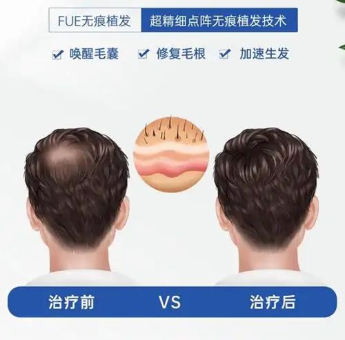 三、合肥大麦微针植发医生团队：与经验的确保