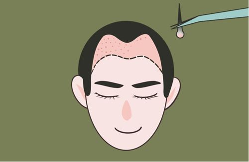 四、合肥大麦微针植发价格体系：透明合理，性价比高