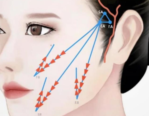 婕尔和伊婉v哪个适合打苹果肌？伊婉v在2026年成为苹果肌填充热门选择