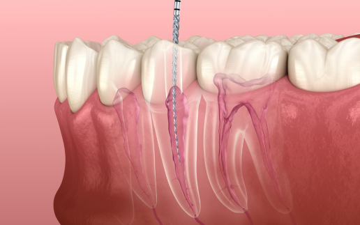 三、根管治疗后是否需要额外费用