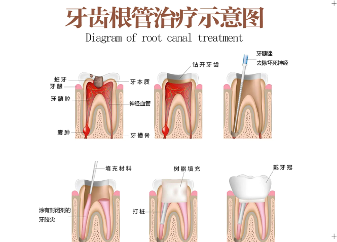 五、根管治疗+冠修复的价格与适用情况