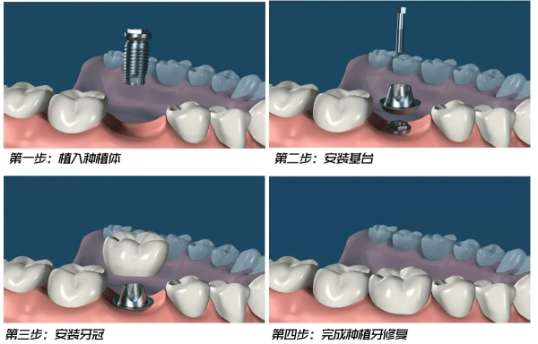 二、科特斯Dynamix种植体的临床应用场景
