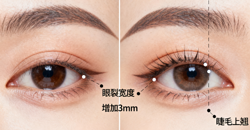 五、杨亚益双眼皮价格：不同项目与费用构成