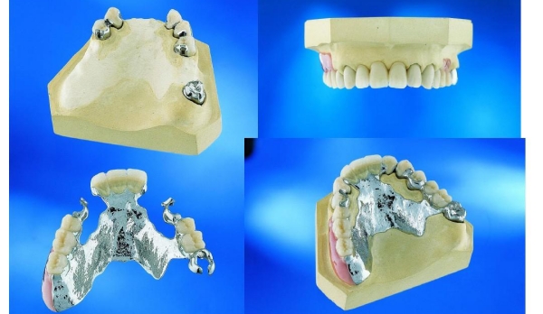 三、挂钩与无挂钩义齿的对比分析
