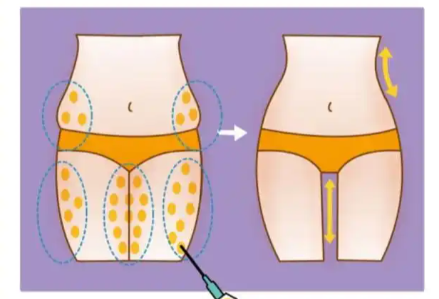 手臂加副乳吸脂多少钱？两个部位价格在1.2万到5万元之间