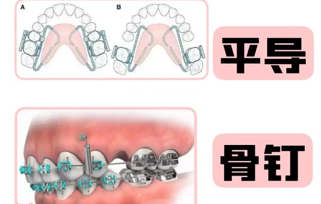 承德隐形透明牙齿矫正器多少钱？隐适美、时代天使基本两万起步
