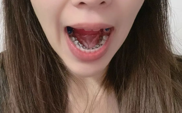 五、舌侧矫正：50000元–80000元