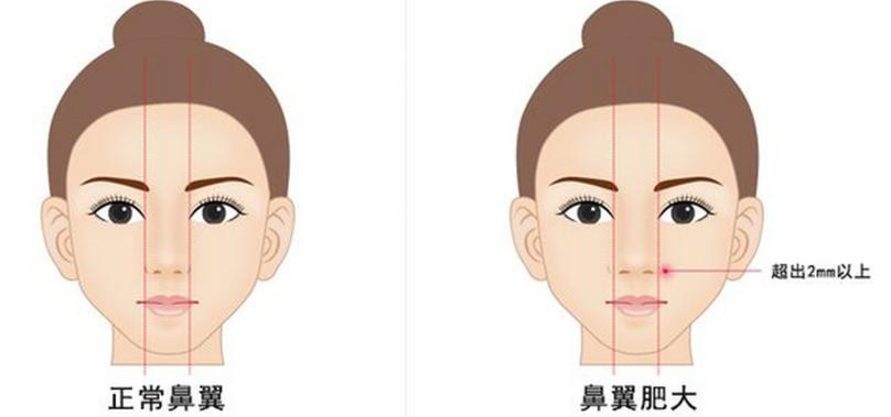 四、成都做鼻子多少钱的影响因素分析