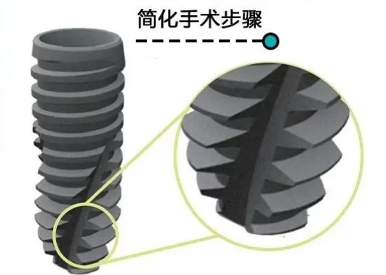 招远单颗种植牙价格多少？国产种植体2000元，进口高品质上万