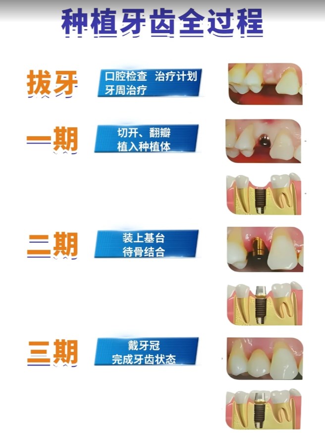 四、招远单颗种植牙价格多少？附加治疗费用