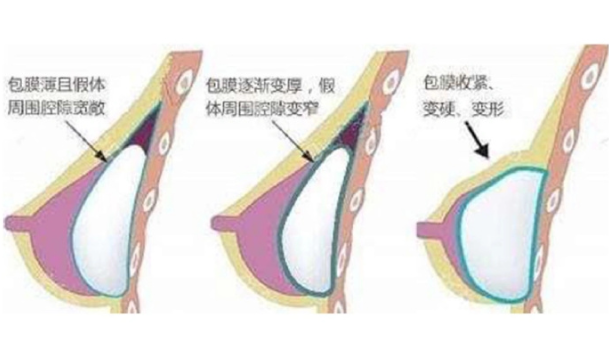 二、成都医生做胸修复多少钱？不同医院的价格差异